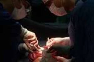 خارج کردن تومور پیشرفته ویلمز از کلیه کودک ۹ساله طی عمل جراحی ۶ ساعته